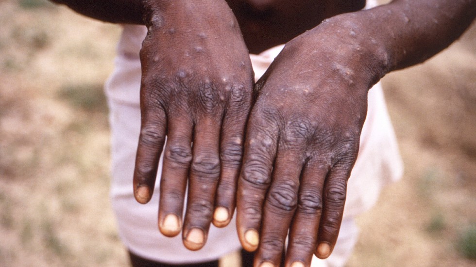 Apkoppor ger upphov till utslag, sår och blåsor. Symtomen är ofta milda men kan bli allvarliga hos personer i riskgrupper. Arkivbild från Kongo-Kinshasa.