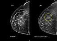 Mammografi i 3D hittar fler tumörer