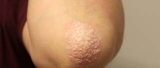 "Nu är jag stolt över min psoriasis"