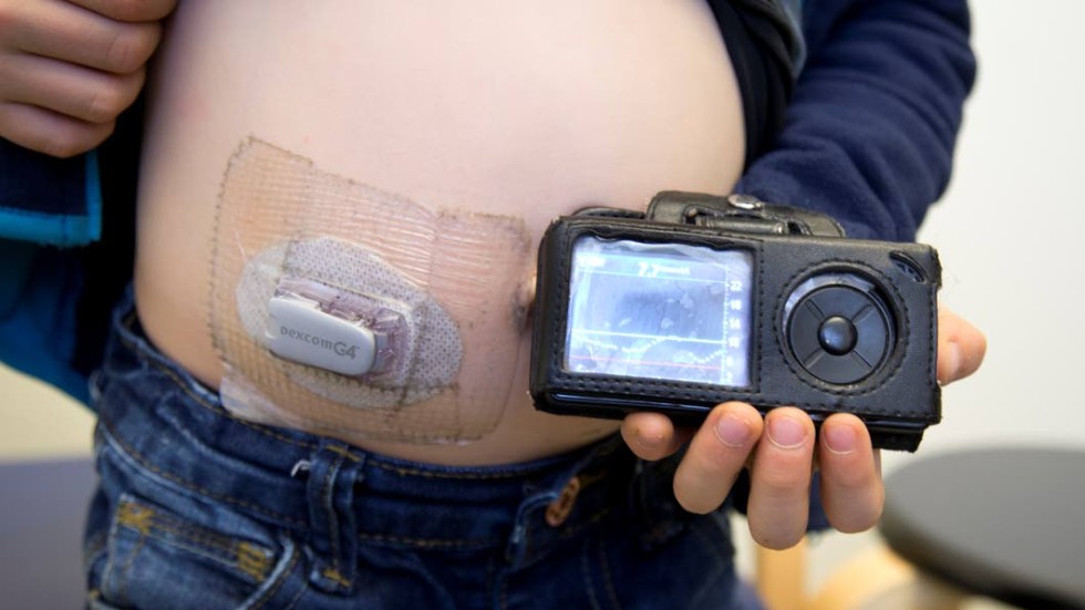 Sensor. Tekniken CGM håller koll på Toms blodsocker med en "puck" på magen och en trådlös handenhet.