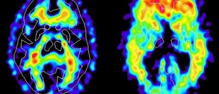 Tvära kast för lovande alzheimerpreparat från Uppsala • Det fick aktien att rasa • Så gick kursen upp igen