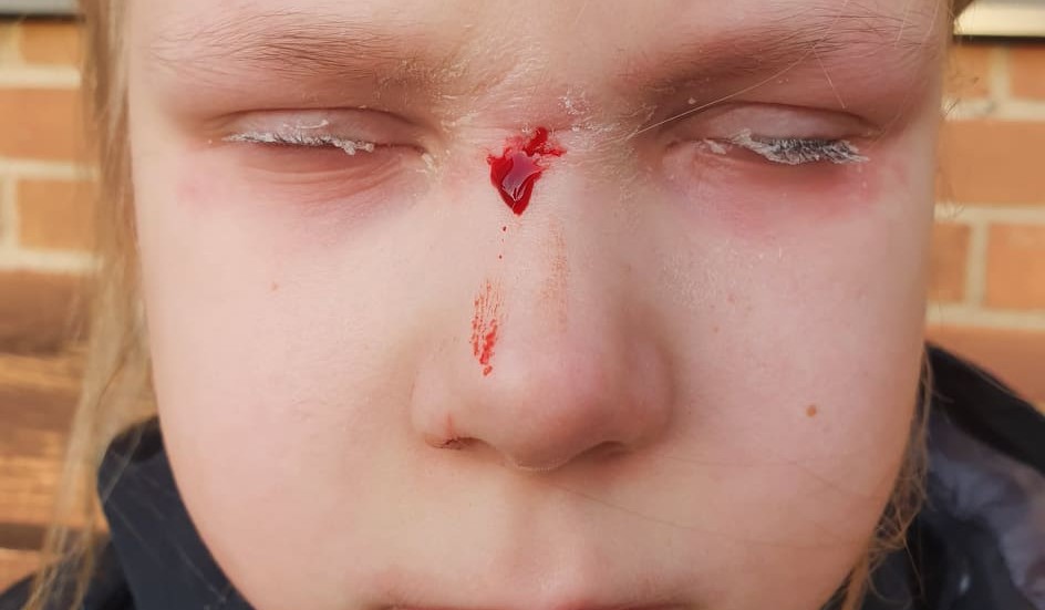 Amelia, 7 år, fick ögonfransarna ihoplimmade under ett besök hos en vårdcentral.