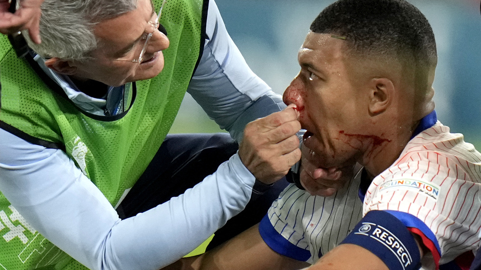 Kylian Mbappé bröt näsan i matchen mot Österrike.