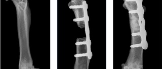 Ny metod läker frakturer med konstgjort ben