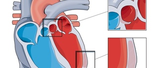 Hjärtpatienter sviks av vården – kunskap saknas